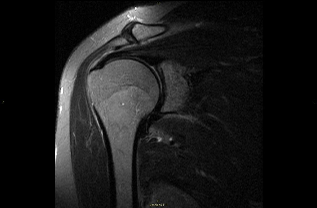 Arthrograms Now at Avala Imaging - AVALA