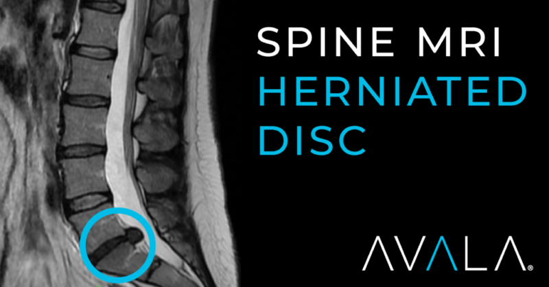 DISC Herniation