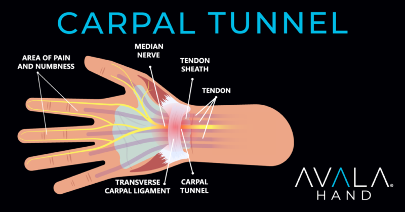 Carpal Tunnel