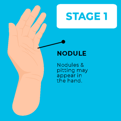 Dupuytren's Contracture AVALA