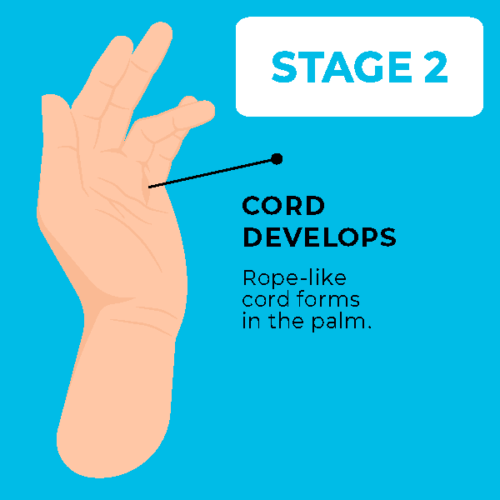 Dupuytren's Contracture AVALA